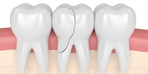 Broken Tooth Treatment Clinic Near Me in Beverly Hills, CA