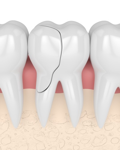 Broken Tooth Near Me in Beverly Hills, CA