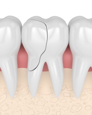 Broken Tooth Near Me in Beverly Hills, CA