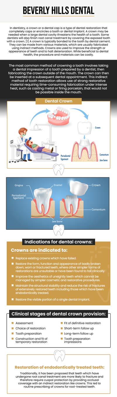 Common questions asked by patients: What is a dental crown and when is it needed? How long does a dental crown last? Are dental crowns painful to get? How much does a dental crown cost in Beverly Hills, CA? For more information, contact us today or book an appointment. We are conveniently located at 414 North Camden Drive #925, Beverly Hills, CA 90210.