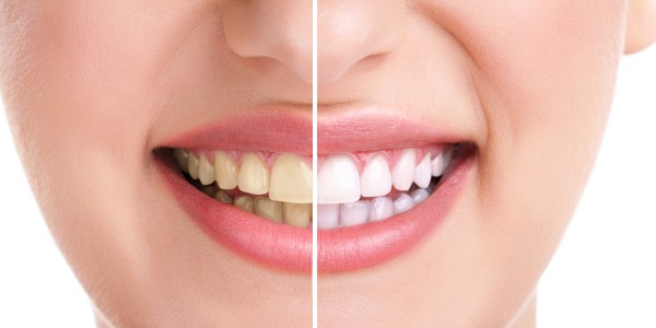 Facelift Dentistry Near Me in Beverly Hills, CA