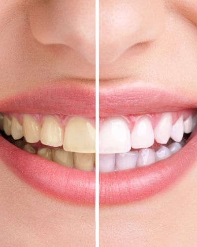 Face Lift Dentistry Near Me in Beverly Hills, CA