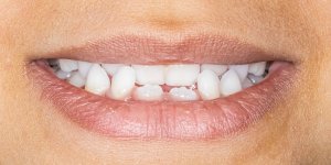 Underbites Treatment Specialist Near Me in Beverly Hills, CA