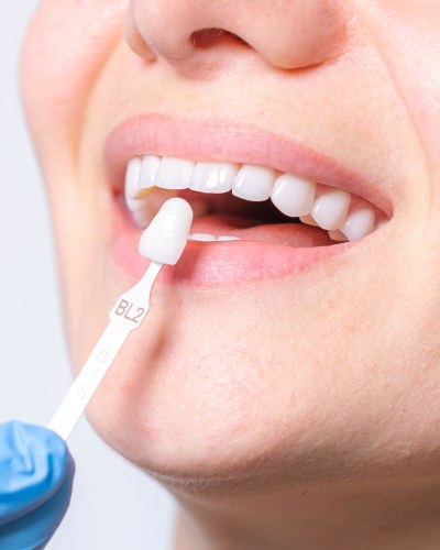 Veneers Near Me in Beverly Hills, CA