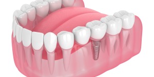 Zirconia Dental Implants Specialist Near Me in Beverly Hills, CA