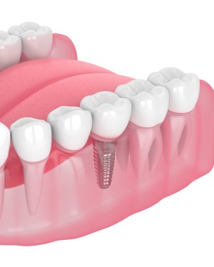 Zirconia Implants Near Me in Beverly Hills, CA